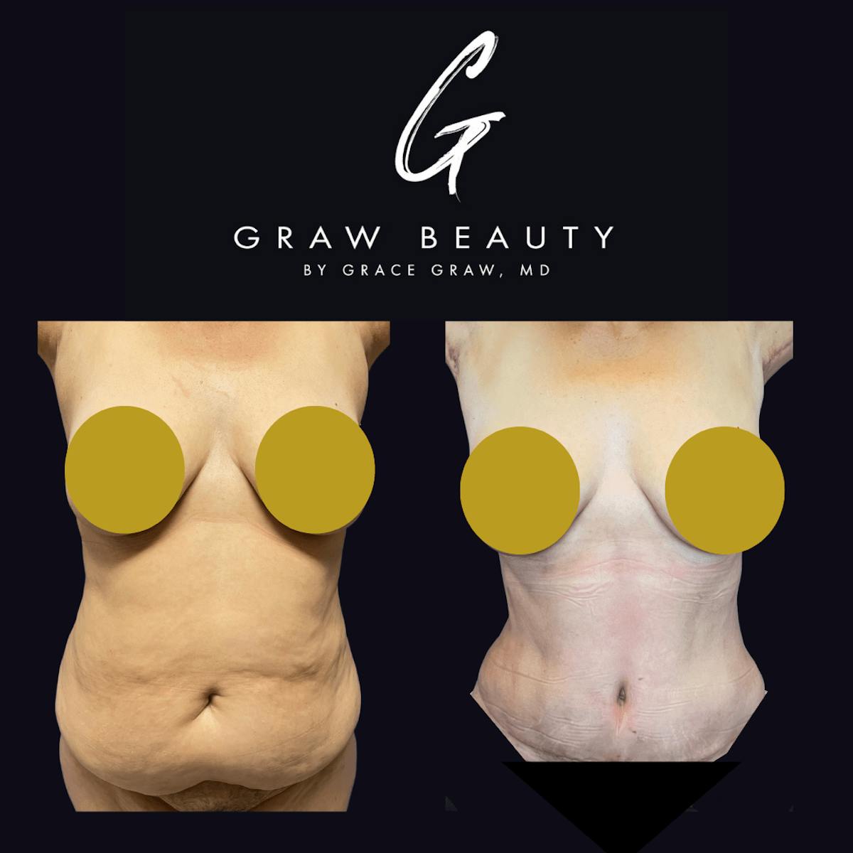 Abdominoplasty Before & After Gallery - Patient 122446281 - Image 1