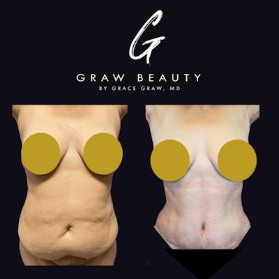 Abdominoplasty Before & After Gallery - Patient 122446281 - Image 1