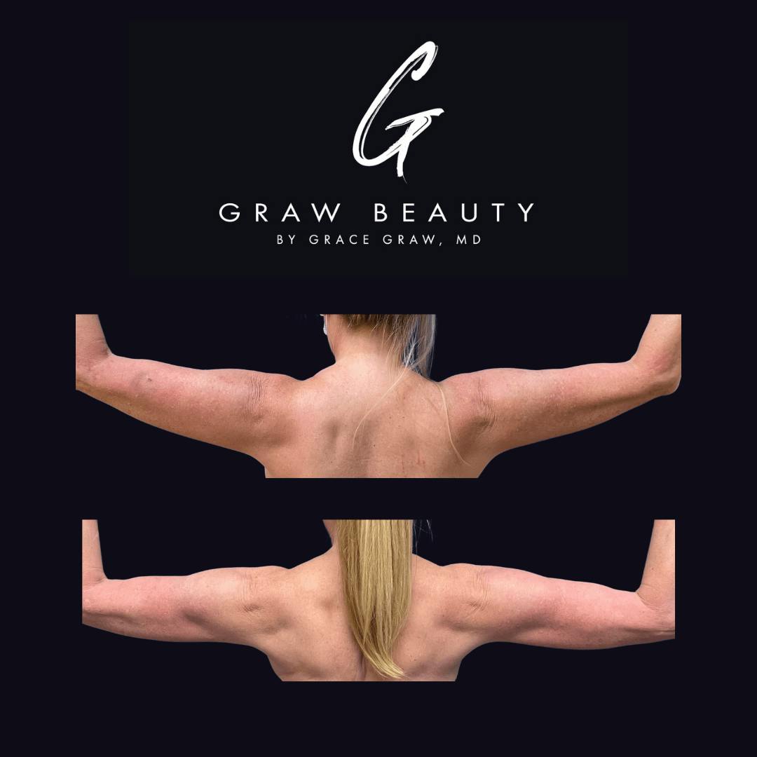 before image of high definition liposuction patient