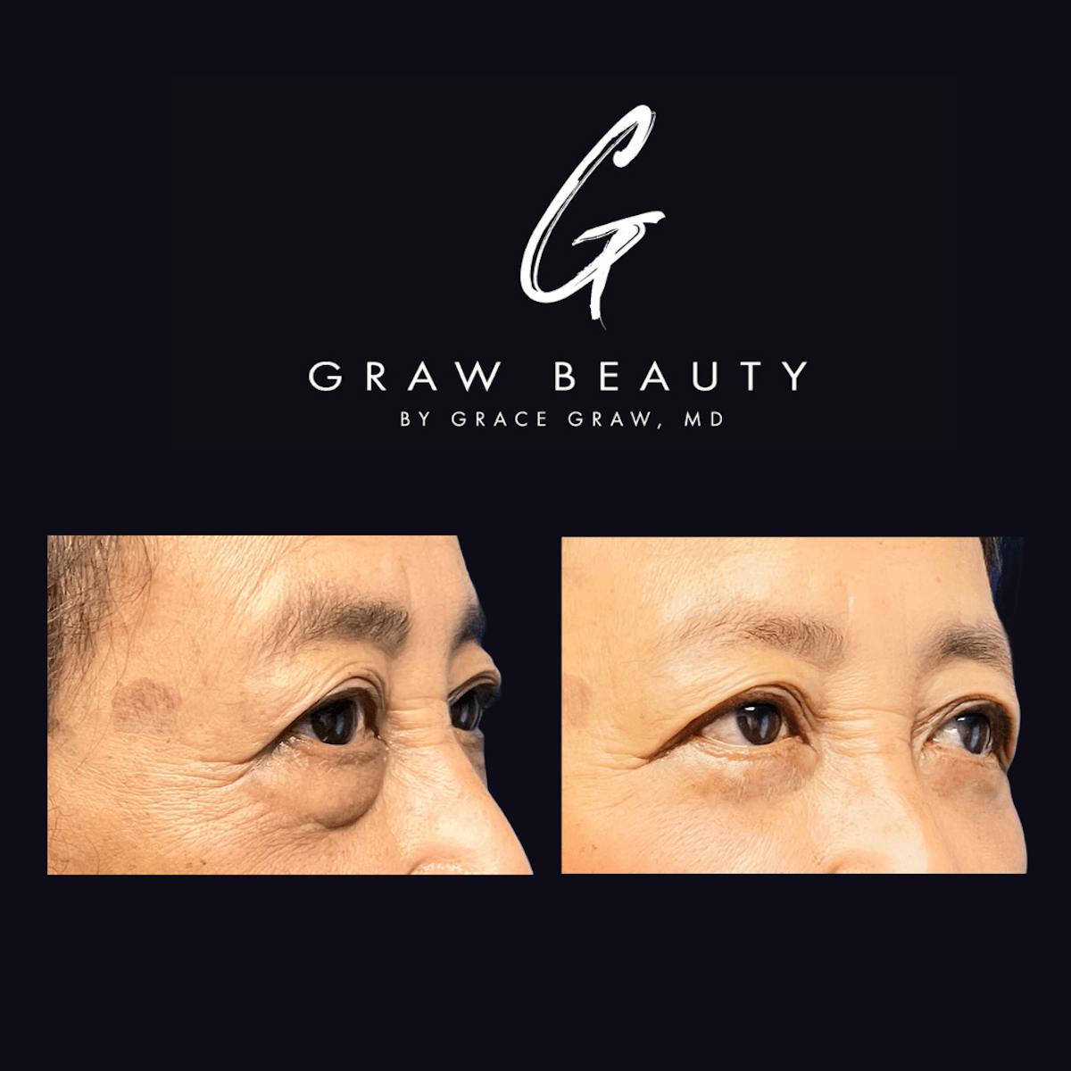 Eyelids Before & After Gallery - Patient 122446378 - Image 3
