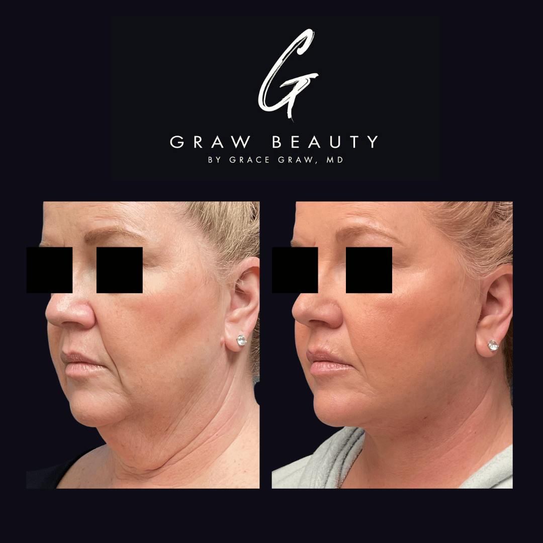 Face and Neck Before & After Gallery - Patient 122446370 - Image 2