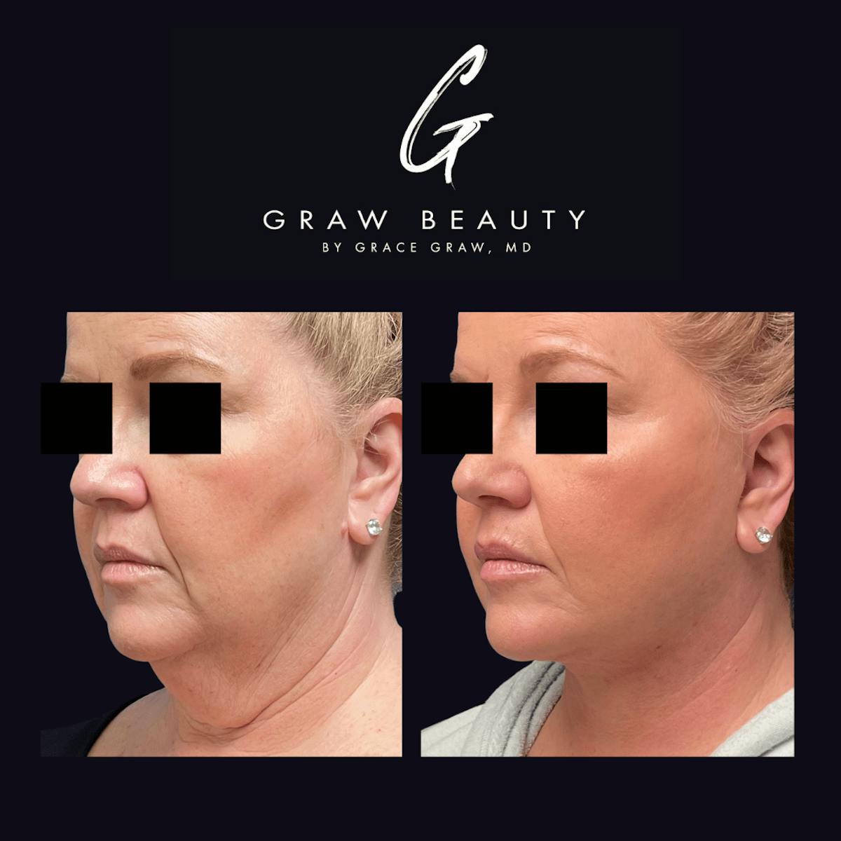 Face and Neck Before & After Gallery - Patient 122446370 - Image 2