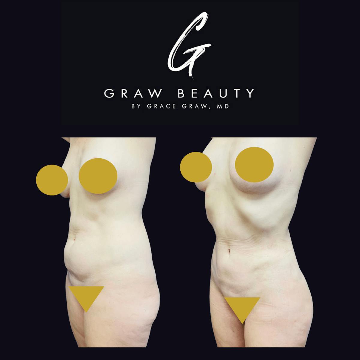 Liposuction Before & After Gallery - Patient 122446432 - Image 2