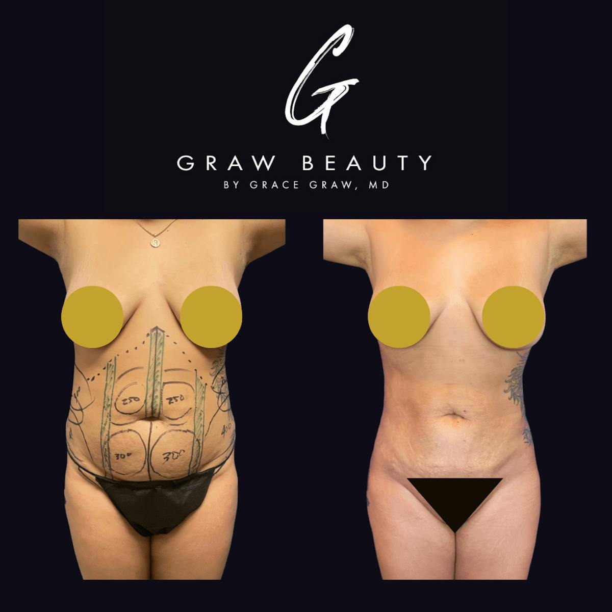 Liposuction Before & After Gallery - Patient 122446436 - Image 1