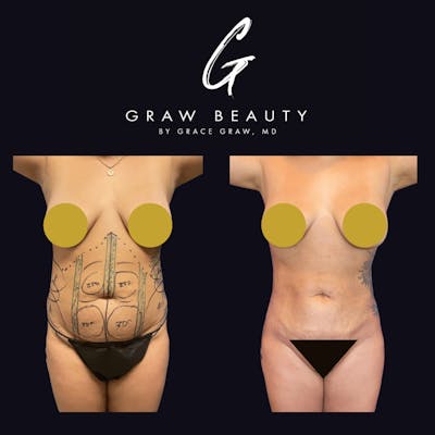 Liposuction Before & After Gallery - Patient 122446436 - Image 1
