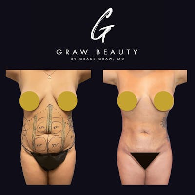 Liposuction Before & After Gallery - Patient 122446436 - Image 1