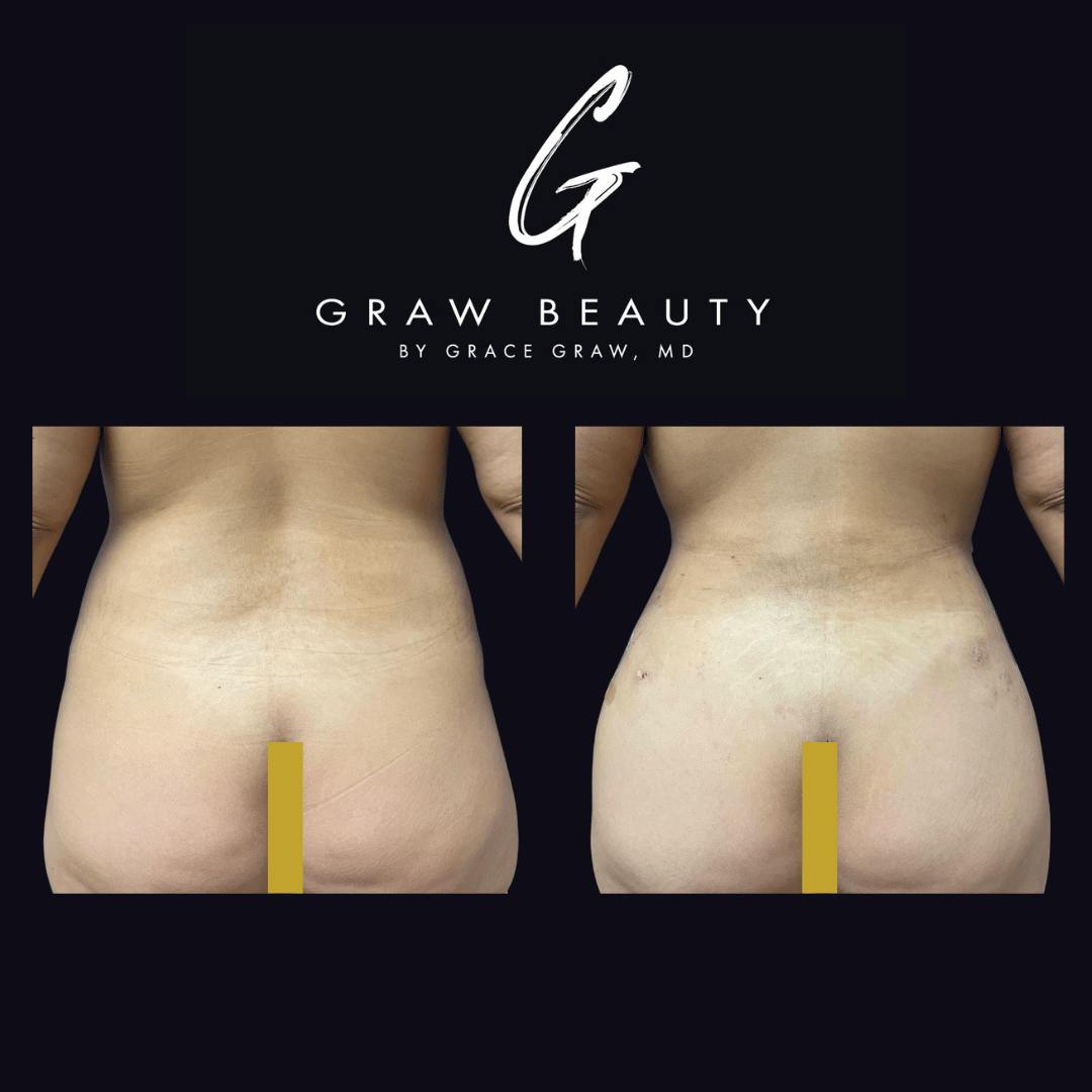 Liposuction Before & After Gallery - Patient 122446437 - Image 1