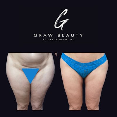 Liposuction Before & After Gallery - Patient 122446439 - Image 1