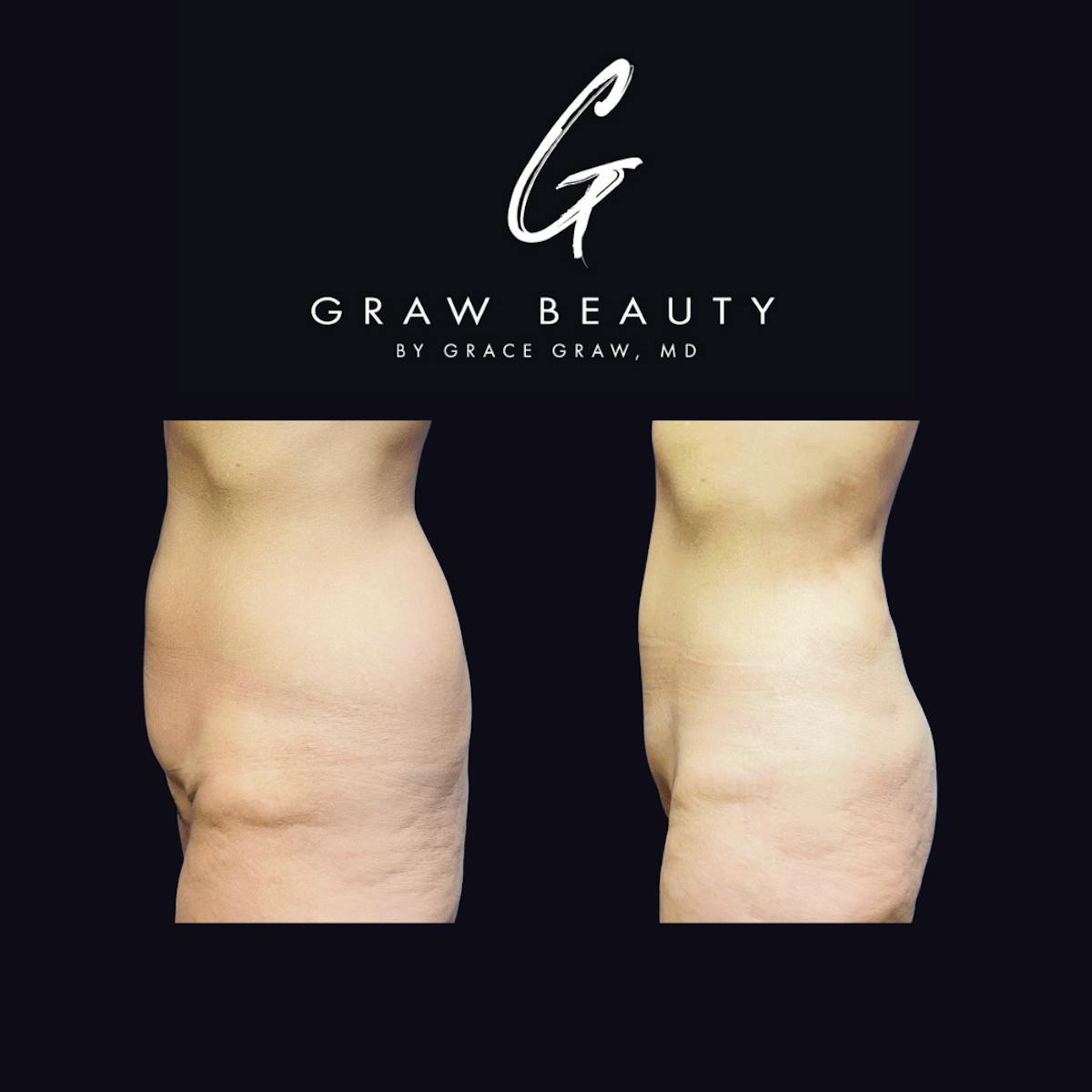 Liposuction Before & After Gallery - Patient 122446440 - Image 2