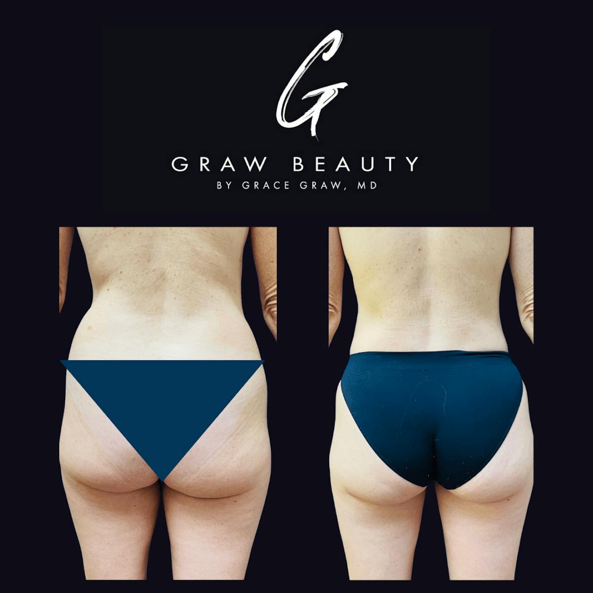 Liposuction Before & After Gallery - Patient 122446443 - Image 1