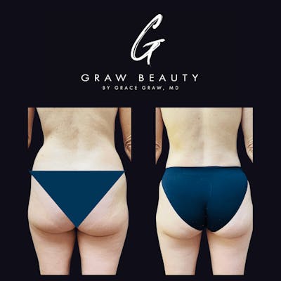 Liposuction Before & After Gallery - Patient 122446443 - Image 1