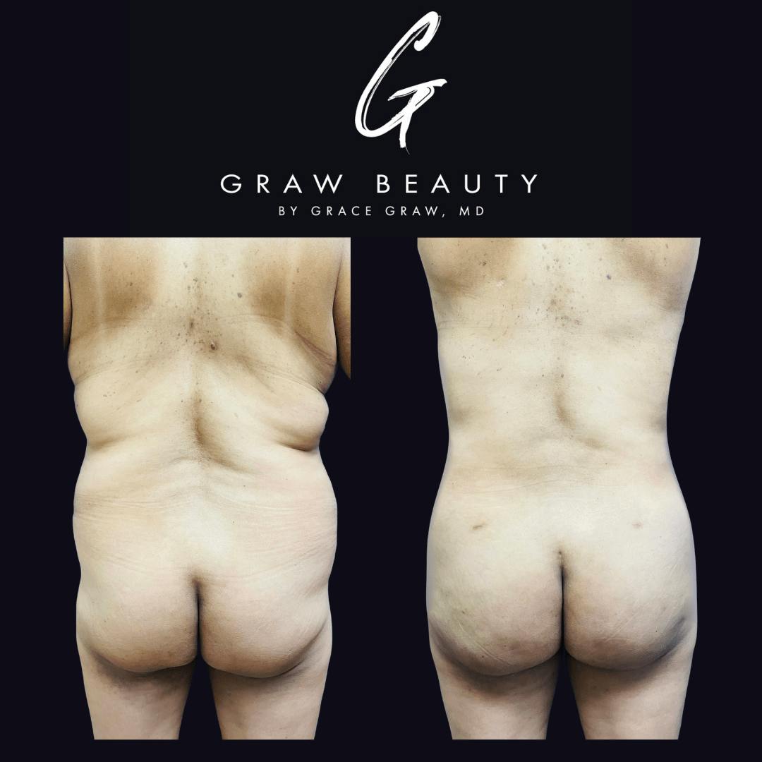 Liposuction + Fat Grafting Before & After Gallery - Patient 122446490 - Image 1
