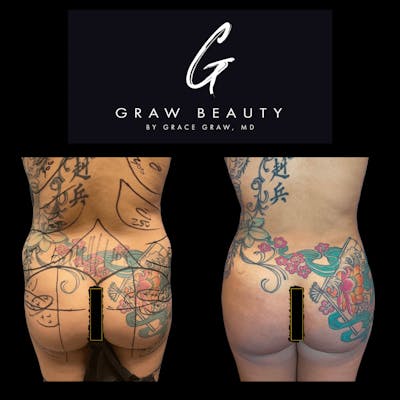 Liposuction + Fat Grafting Before & After Gallery - Patient 122446491 - Image 1