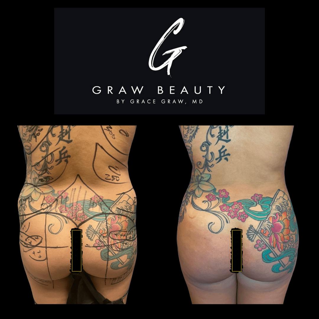 Liposuction + Fat Grafting Before & After Gallery - Patient 122446491 - Image 1