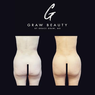 Liposuction + Fat Grafting Before & After Gallery - Patient 122446492 - Image 1