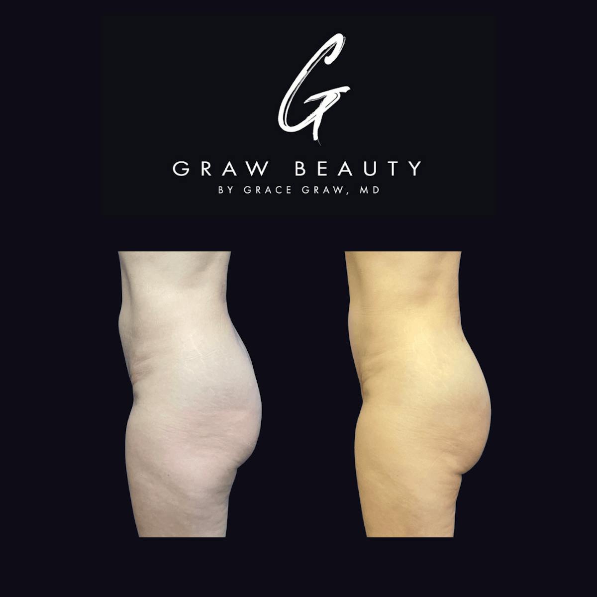 Liposuction + Fat Grafting Before & After Gallery - Patient 122446492 - Image 2