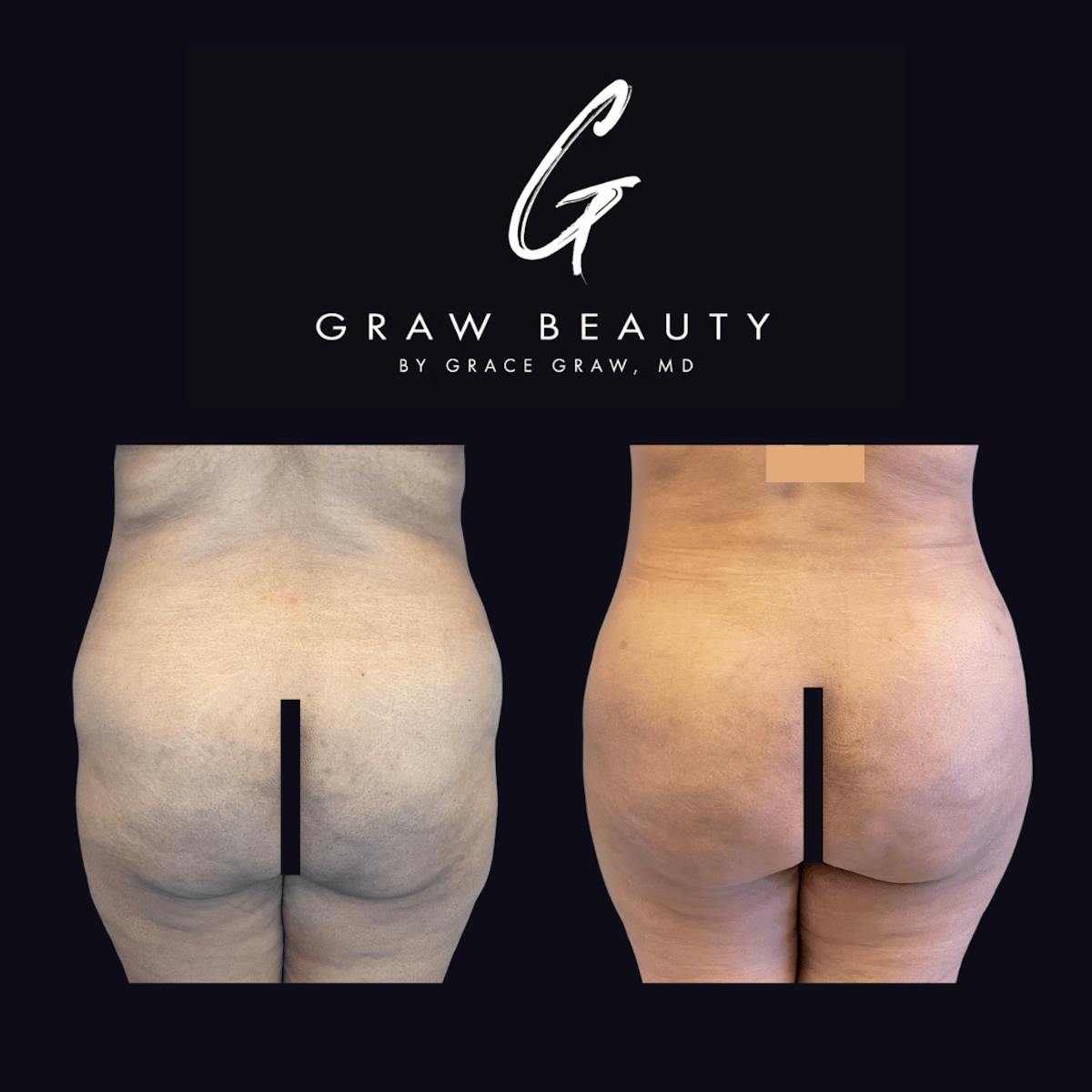 Liposuction + Fat Grafting Before & After Gallery - Patient 122446493 - Image 1