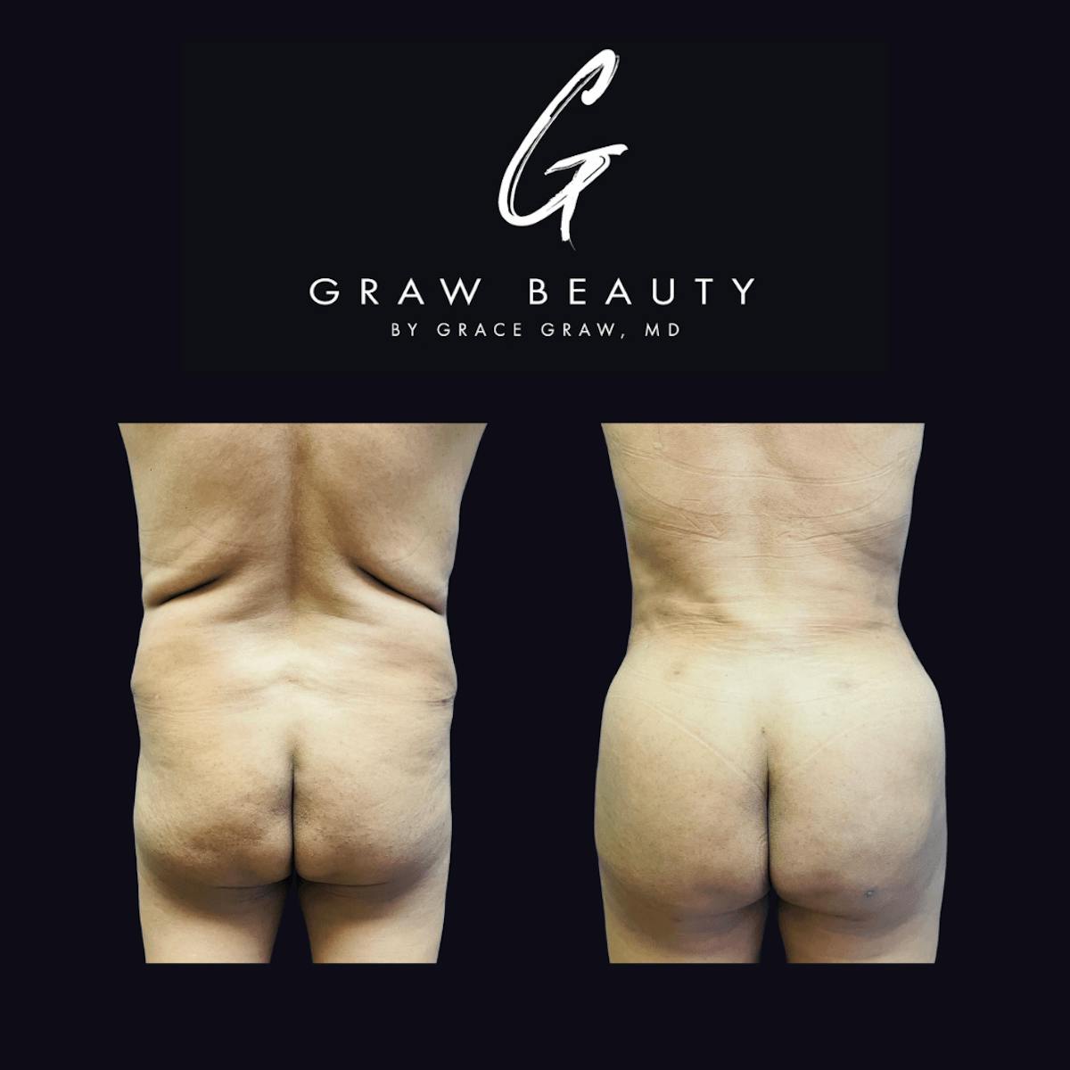 Liposuction + Fat Grafting Before & After Gallery - Patient 122446494 - Image 1
