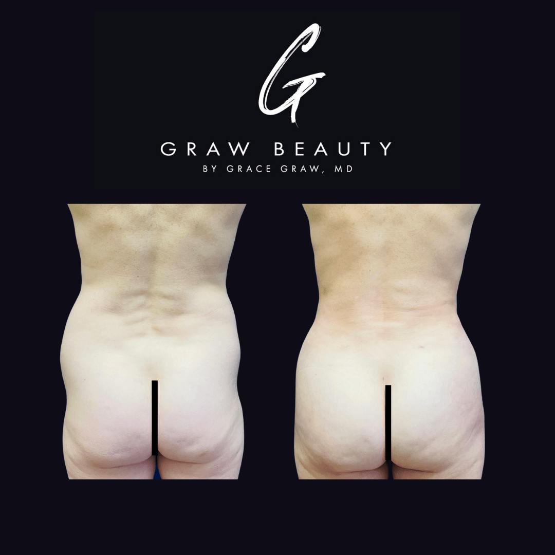 Liposuction + Fat Grafting Before & After Gallery - Patient 122446495 - Image 1