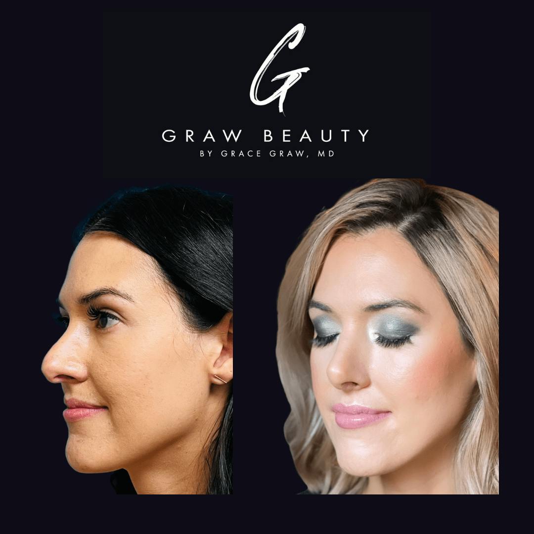 before image of revision rhinoplasty patient