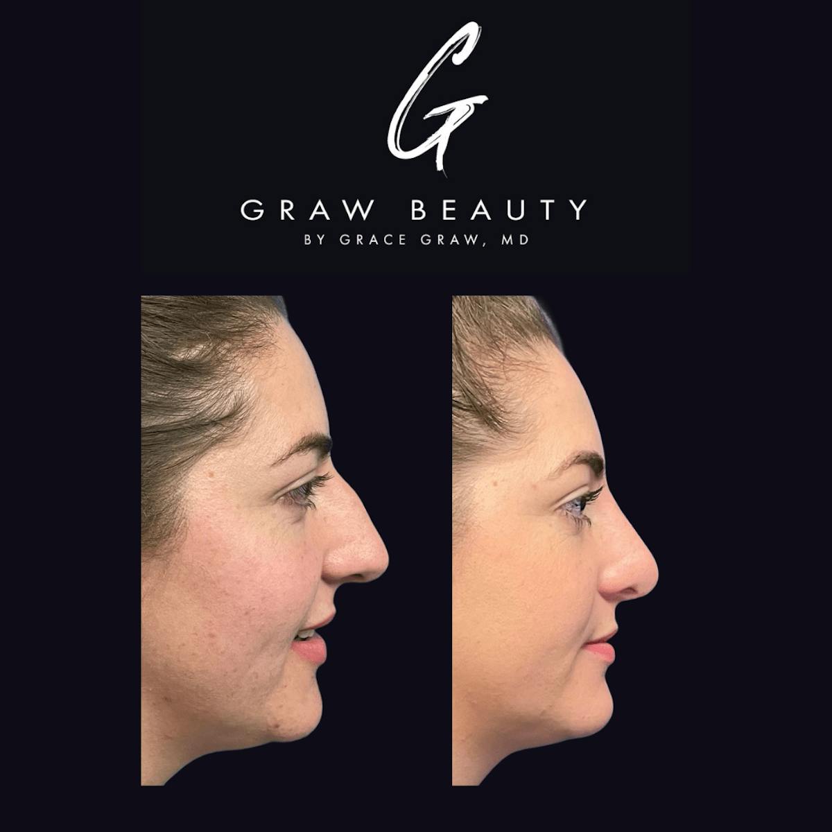Nose Before & After Gallery - Patient 122446501 - Image 2