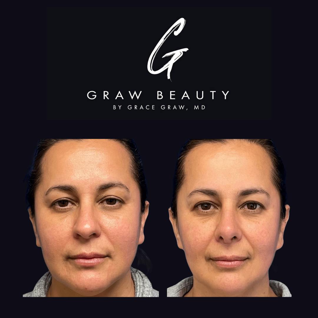 Nose Before & After Gallery - Patient 122446502 - Image 1