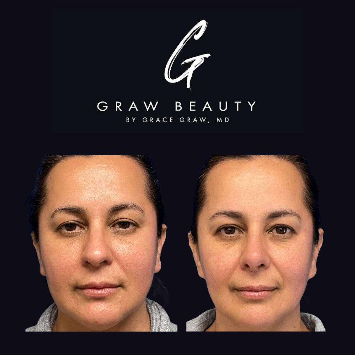 Nose Before & After Gallery - Patient 122446502 - Image 1