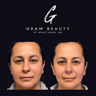 Nose Before & After Gallery - Patient 122446502 - Image 1