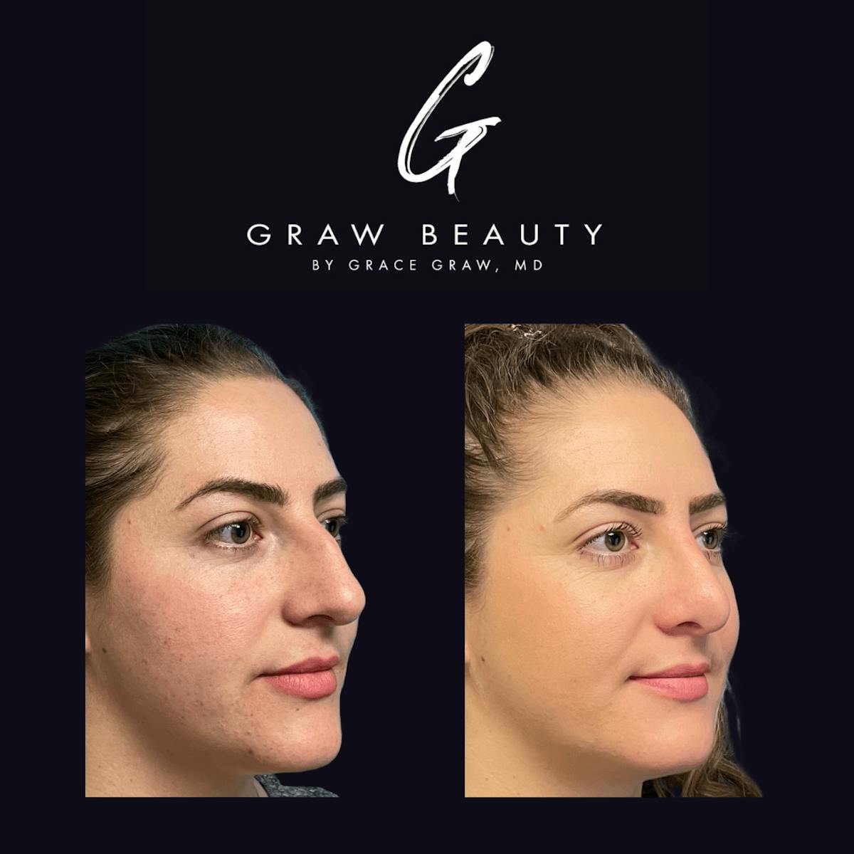 Nose Before & After Gallery - Patient 122446501 - Image 3