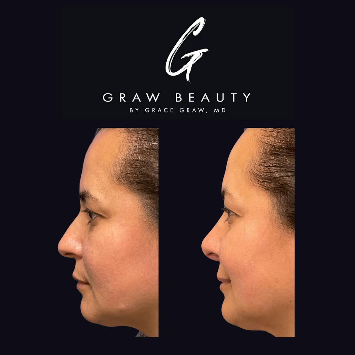 Nose Before & After Gallery - Patient 122446502 - Image 2
