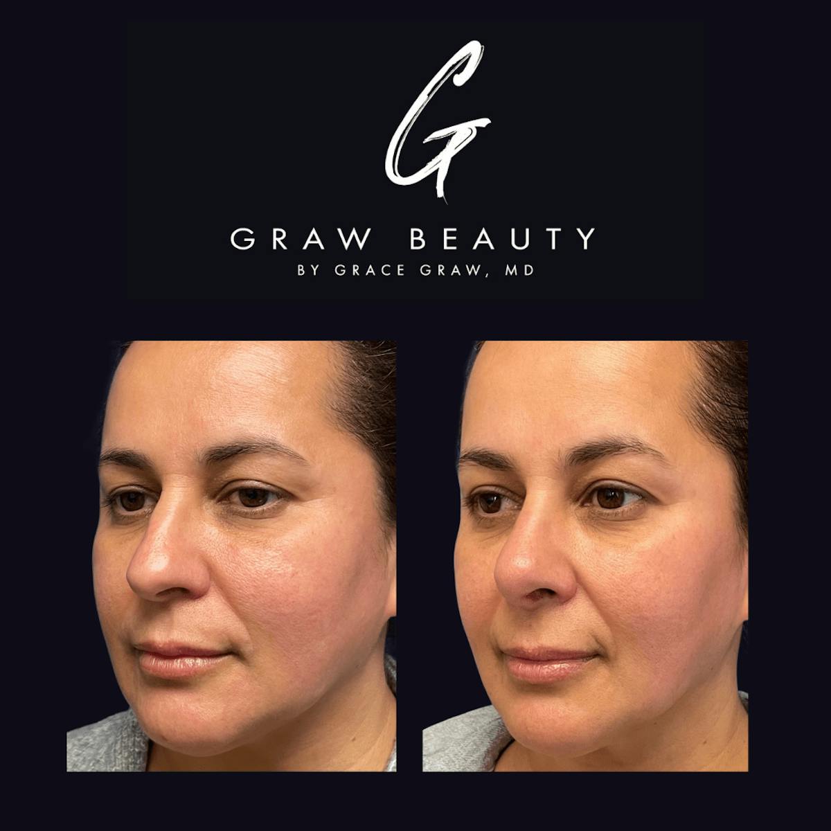 Nose Before & After Gallery - Patient 122446502 - Image 3