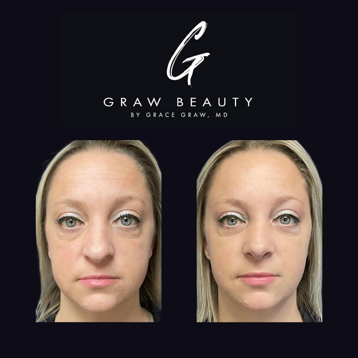 Nose Before & After Gallery - Patient 122446504 - Image 1