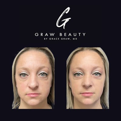 Nose Before & After Gallery - Patient 122446504 - Image 1