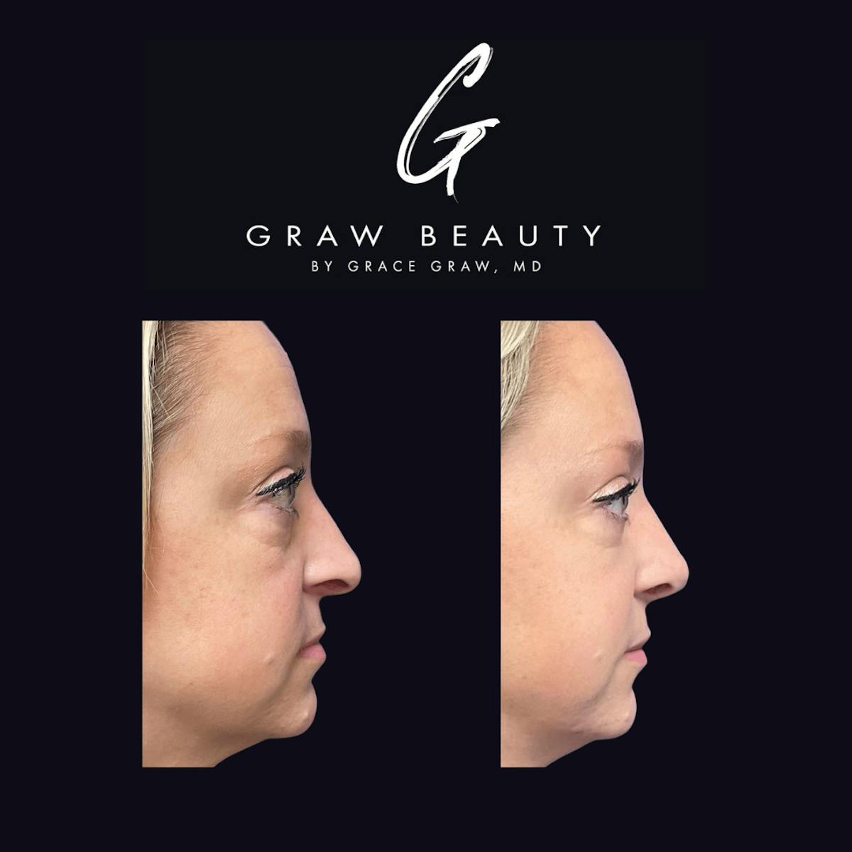 Nose Before & After Gallery - Patient 122446504 - Image 2