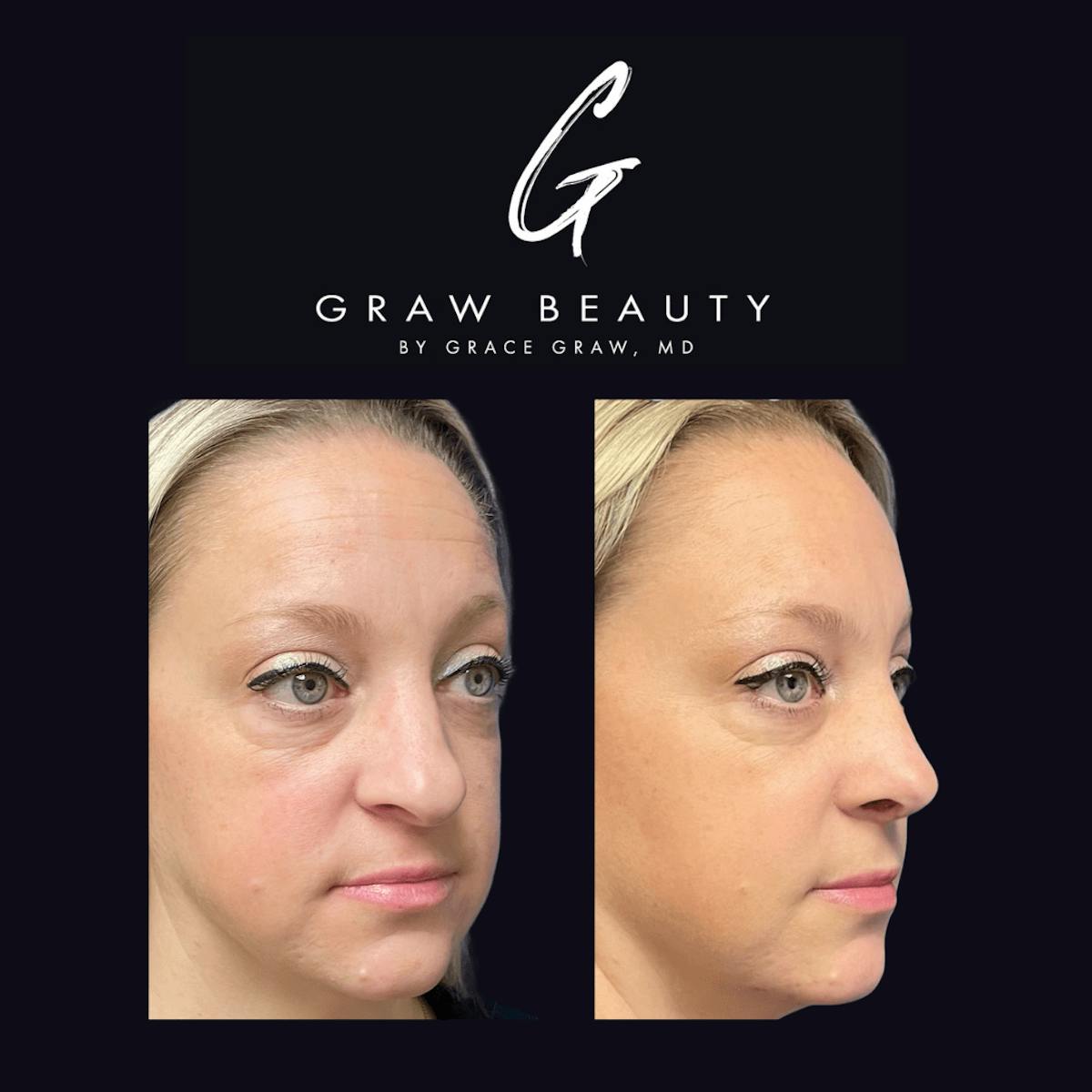Nose Before & After Gallery - Patient 122446504 - Image 3