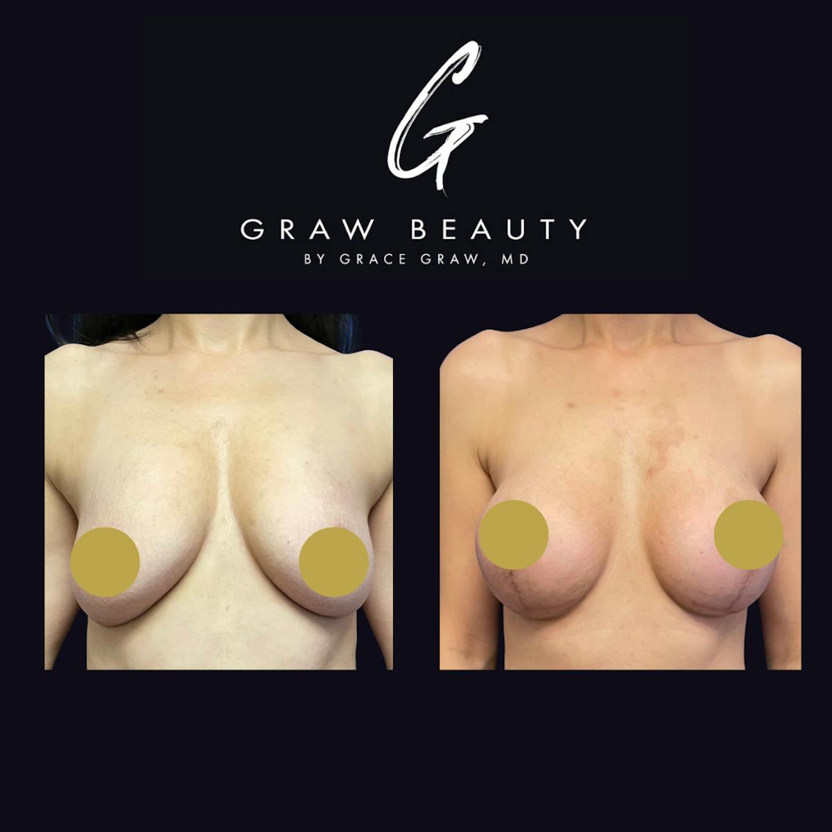 Breast Augmentation Before & After Gallery - Patient 122446527 - Image 1