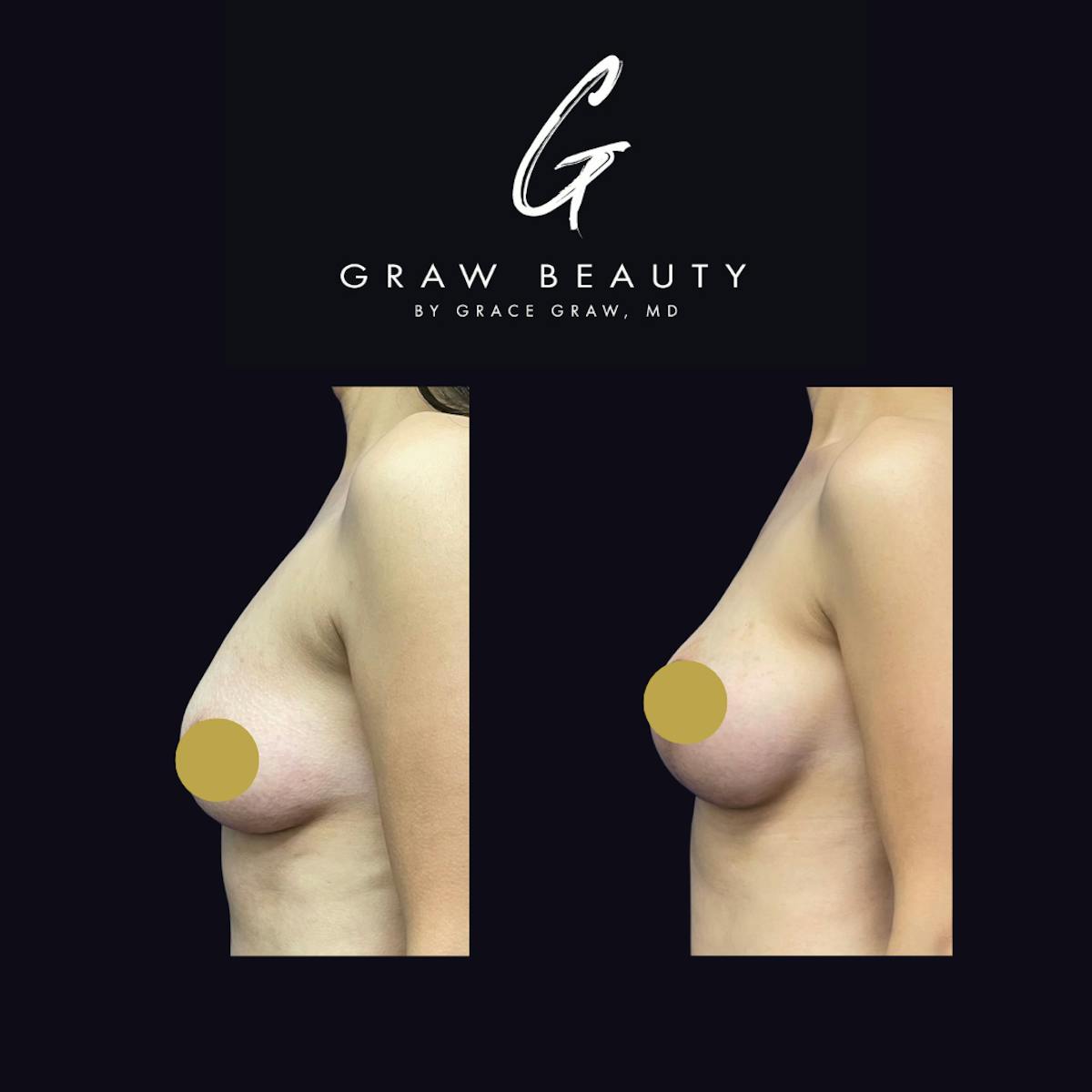 Breast Augmentation Before & After Gallery - Patient 122446527 - Image 2