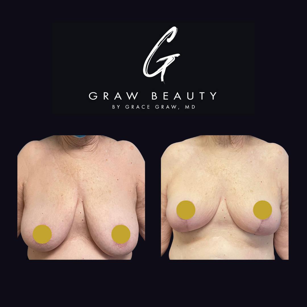 before image of breast reduction patient