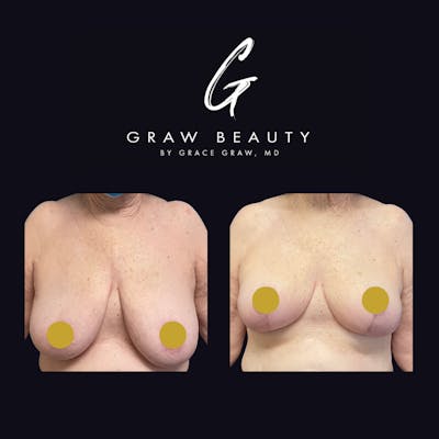 Breast Reduction Before & After Gallery - Patient 122446522 - Image 1