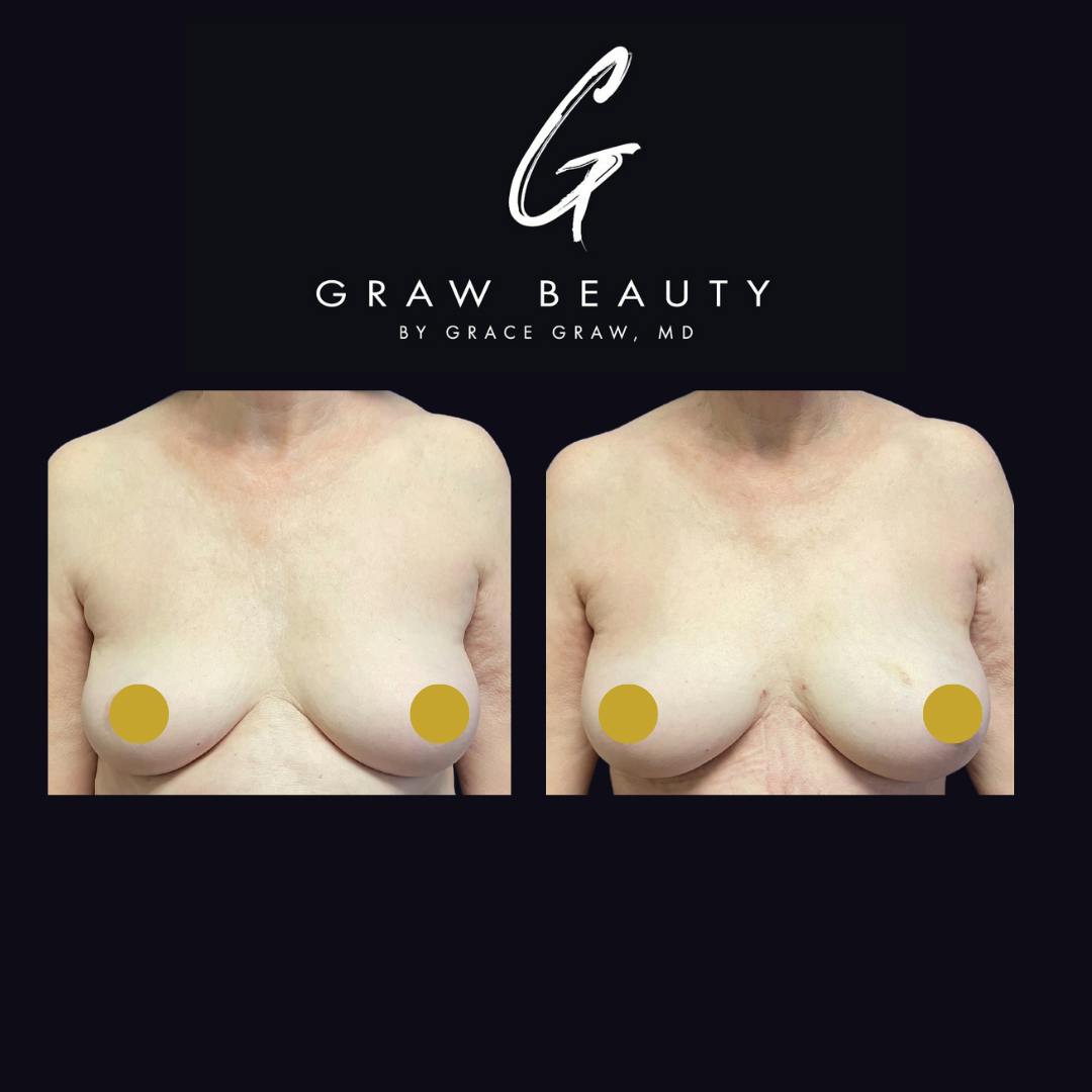 before image of breast fat grafting patient