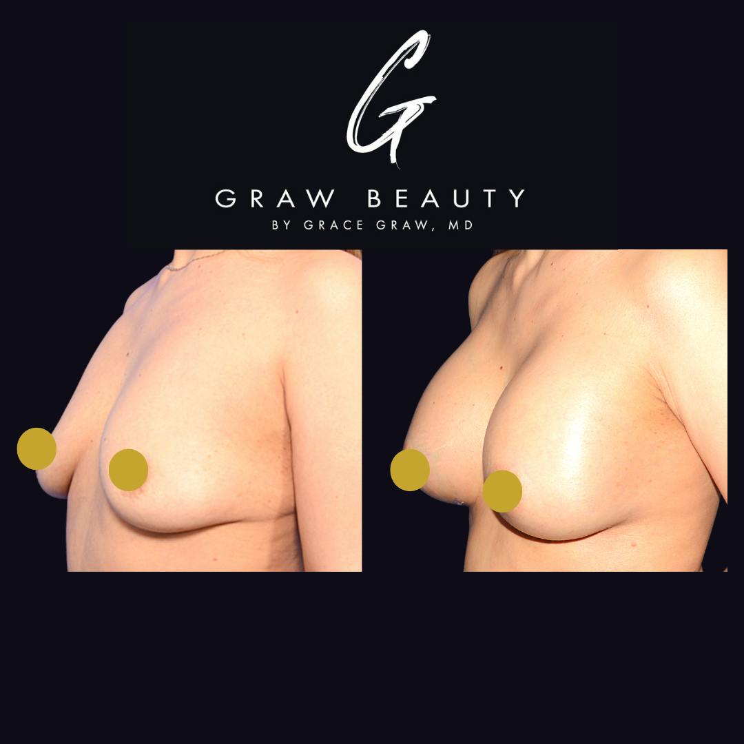 before image of breast augmentation patient