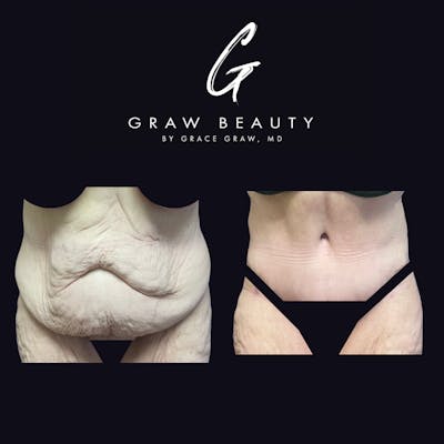 Abdominoplasty Before & After Gallery - Patient 123173885 - Image 1