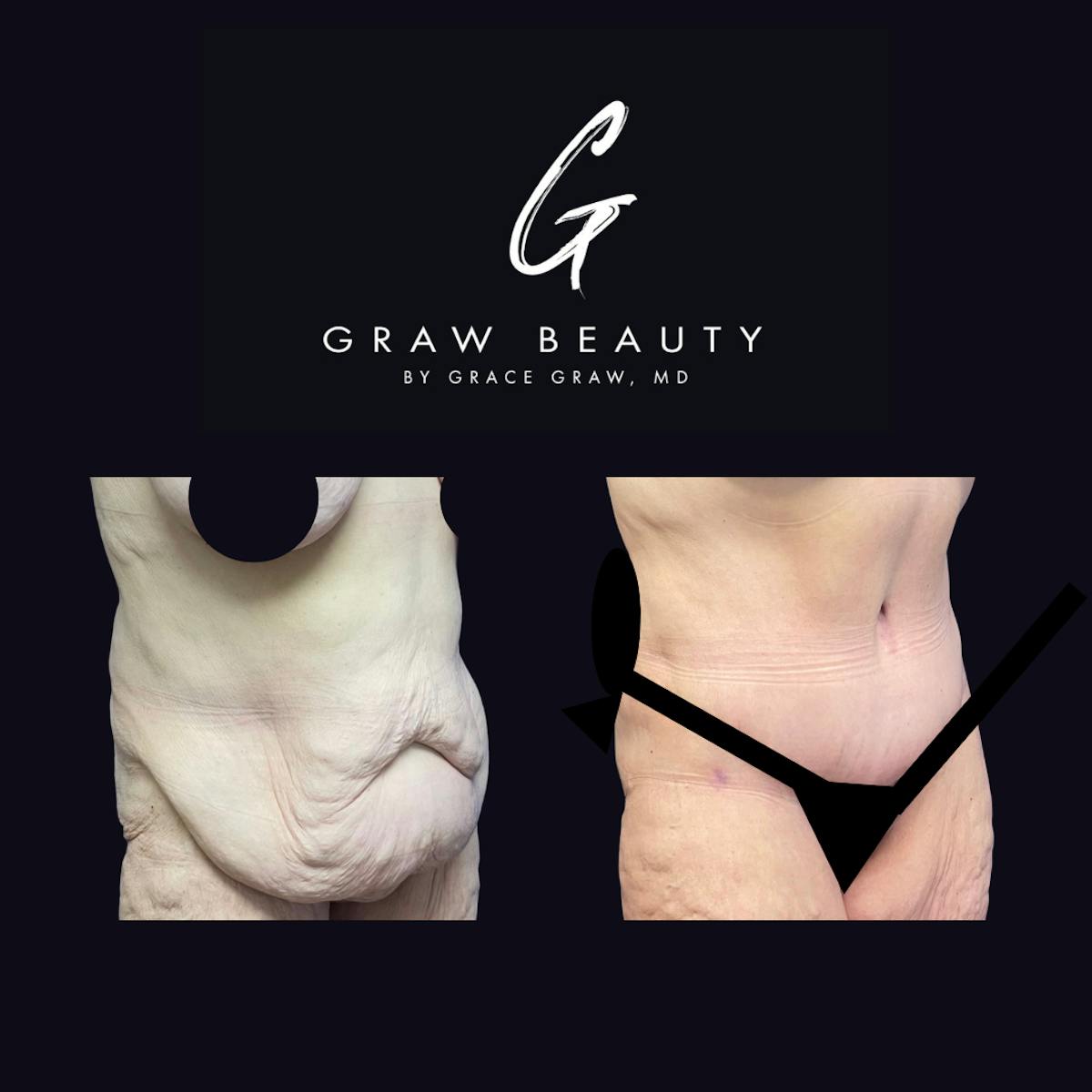 Abdominoplasty Before & After Gallery - Patient 123173885 - Image 2