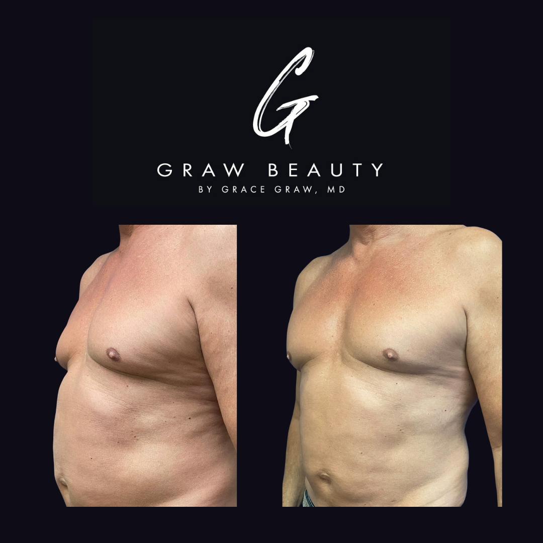 Liposuction + Fat Grafting Before & After Gallery - Patient 123173894 - Image 1