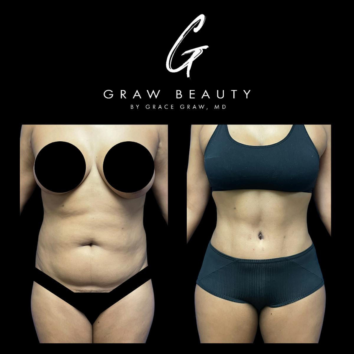 Abdominoplasty Before & After Gallery - Patient 147739598 - Image 1