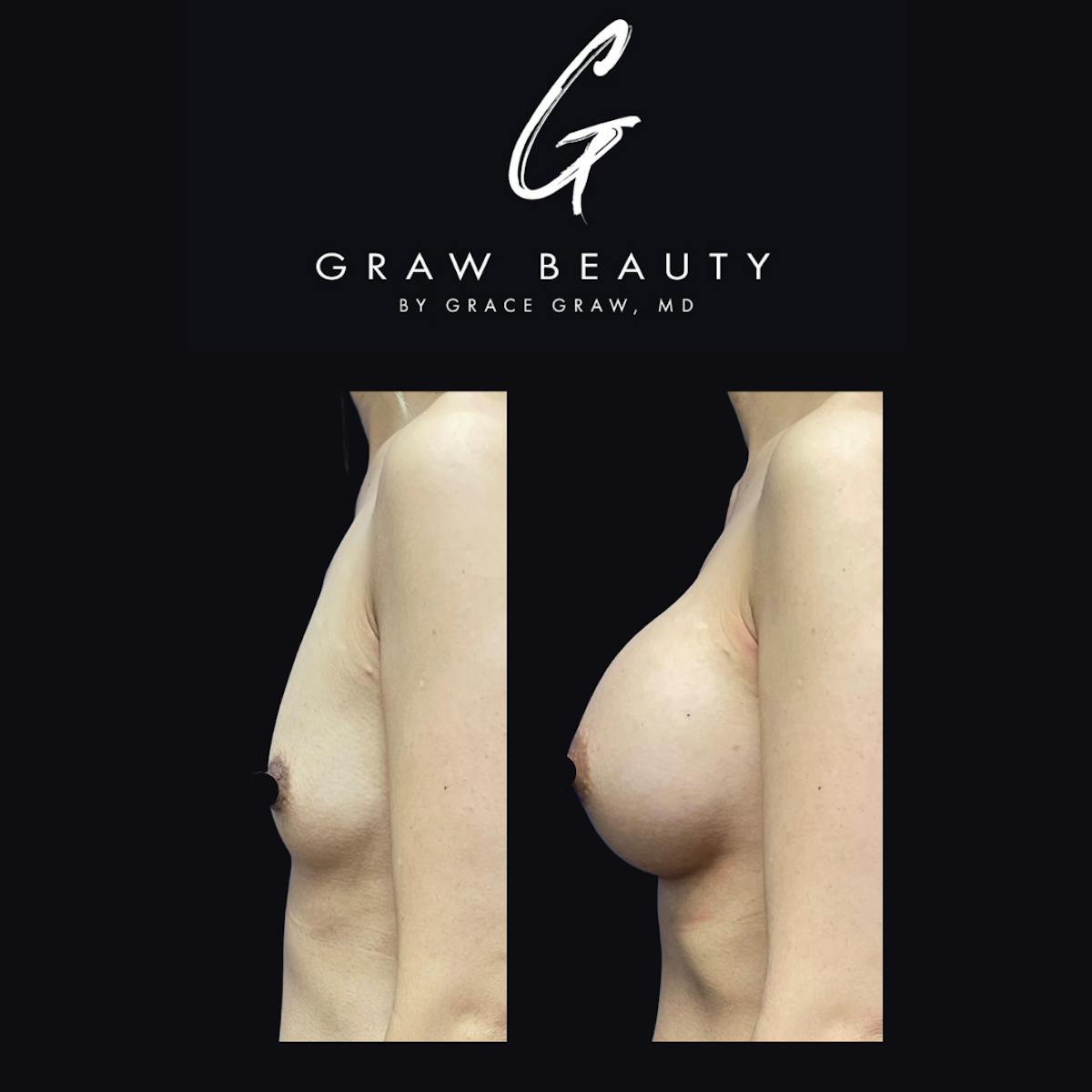Breast Augmentation Before & After Gallery - Patient 147739605 - Image 2