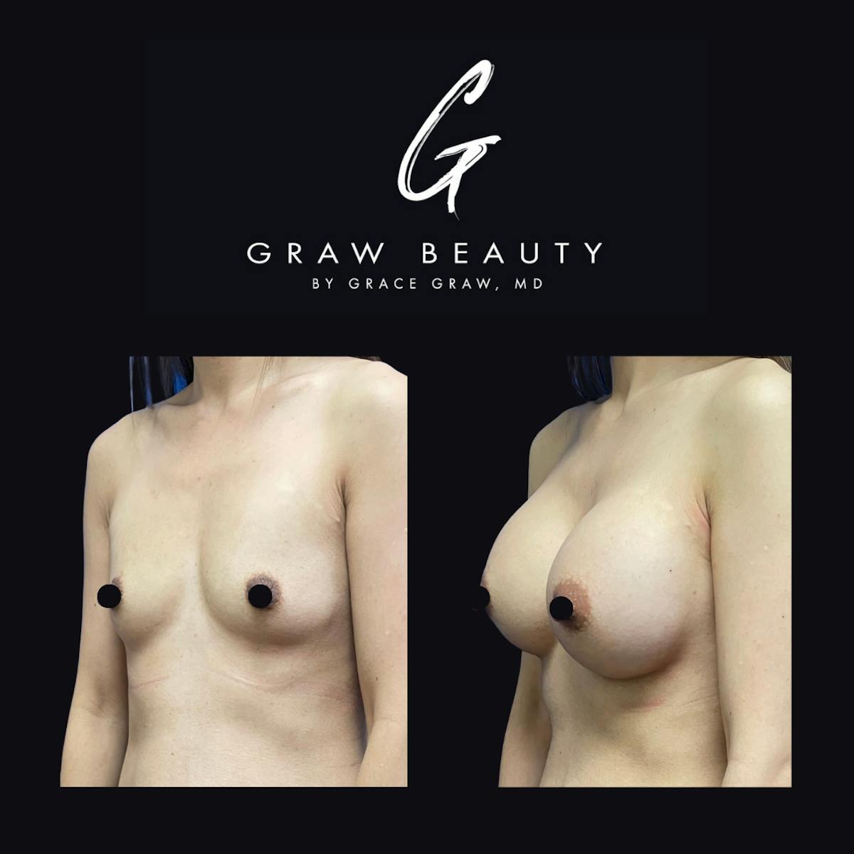 Breast Augmentation Before & After Gallery - Patient 147739605 - Image 3