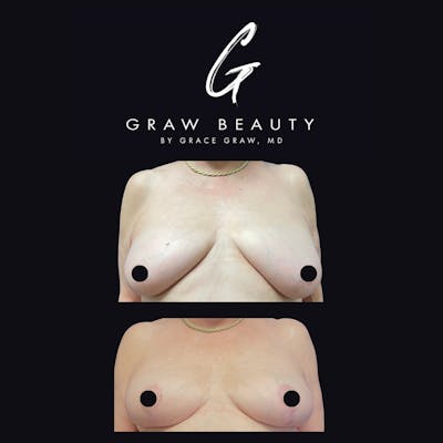 Breast Reduction Before & After Gallery - Patient 147739652 - Image 1