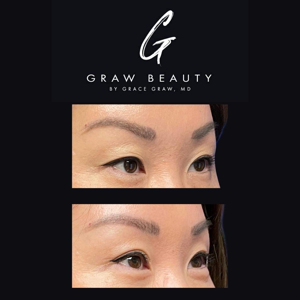 Eyelids Before & After Gallery - Patient 147739667 - Image 2