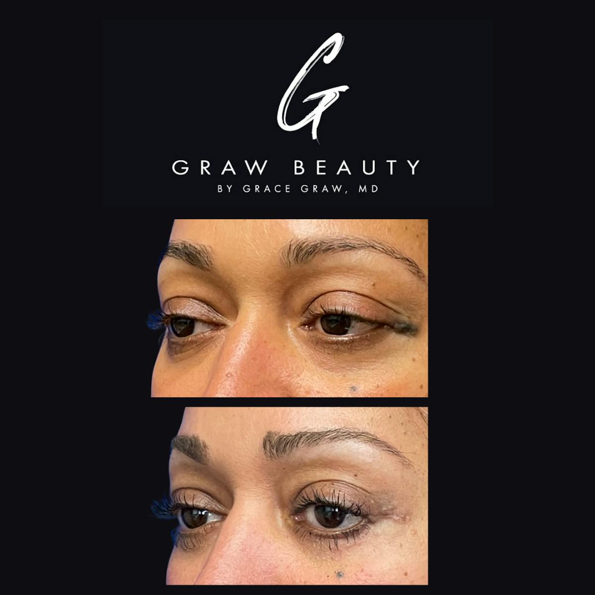 Eyelids Before & After Gallery - Patient 147739675 - Image 2